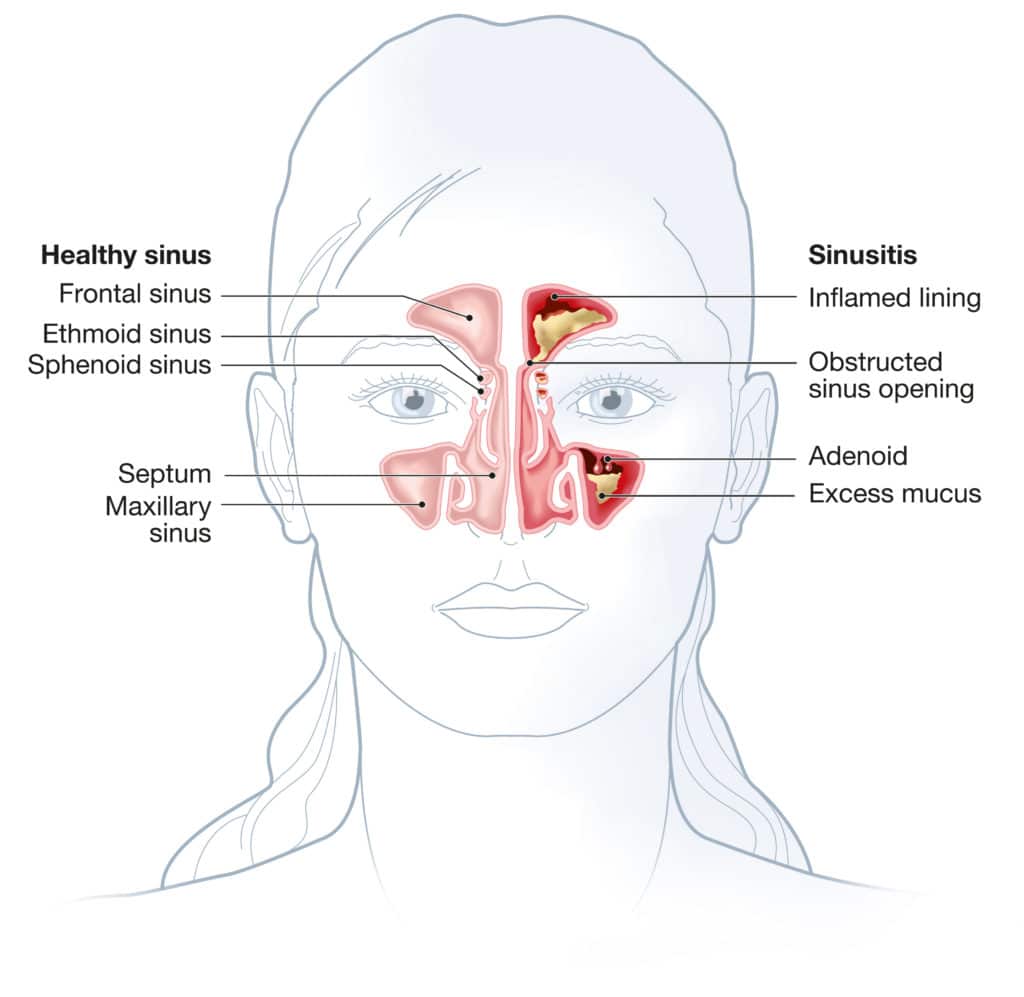 illustration of face with nose cross section, left side of nose healthy, right side of nose with sinusitis